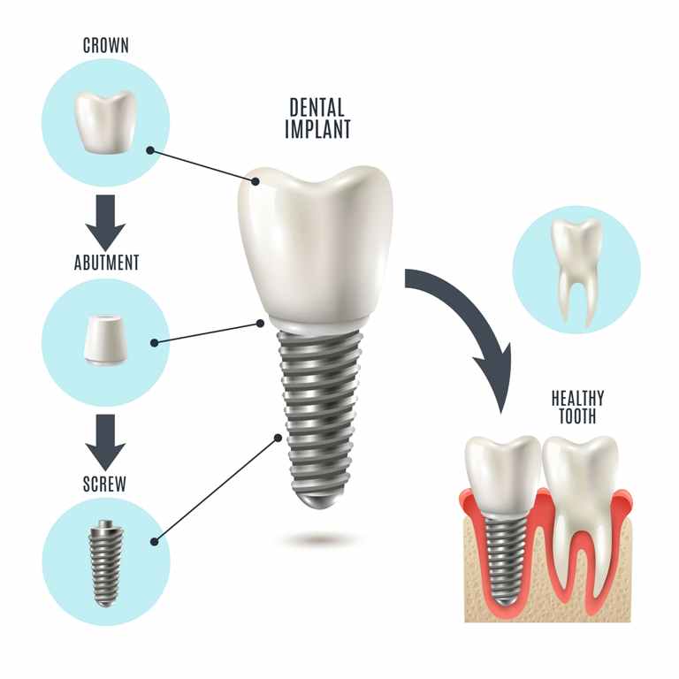 Dental Implants Hartford CT