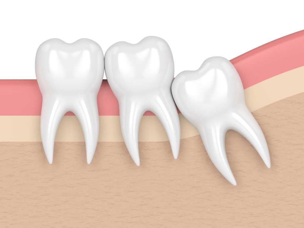 Wisdom Tooth Extraction in Hartford CT