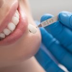6 Side Effects of Dental Veneer Placement - District Dentistry Charlotte